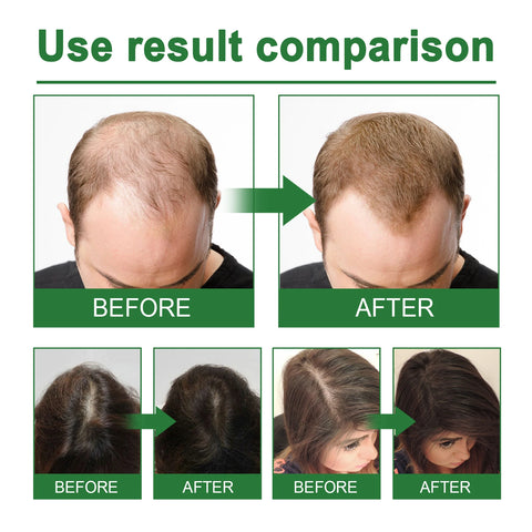 Rosemaries Hair Scalp Care Oil Spray Deep Nourishment Scalp Strengthens Hair Roots Organics Rosemaries Nutrient Essential