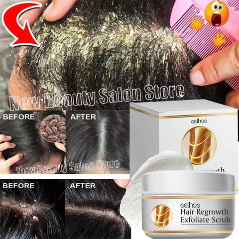 Fast Anti Exfoliating Scrub Remove Dandruff Anti Itching Treatment Seborrheic Scalp Oil Control Repair Scalp Beauty Health Care