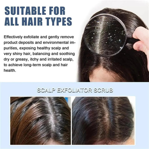 Fast Anti Exfoliating Scrub Remove Dandruff Anti Itching Treatment Seborrheic Scalp Oil Control Repair Scalp Beauty Health Care