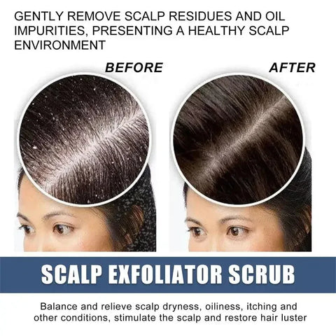 Fast Anti Exfoliating Scrub Remove Dandruff Anti Itching Treatment Seborrheic Scalp Oil Control Repair Scalp Beauty Health Care